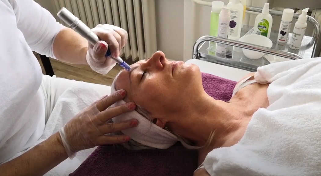 Mezoterapie dermapenem: Účinná a dostupná omlazující procedura - NAFIGATE Cosmetics