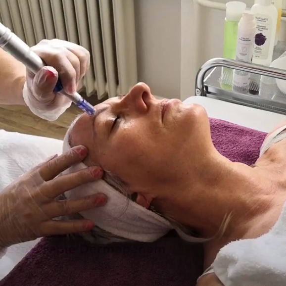 Mezoterapie dermapenem: Účinná a dostupná omlazující procedura - NAFIGATE Cosmetics